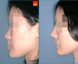 Septal cartilage rhinoplasty