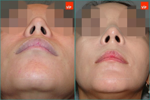 Nose Surgery - Rib cartilage rhinoplasty