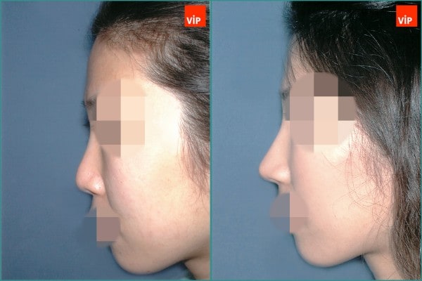 Nose Surgery - Septal cartilage rhinoplasty