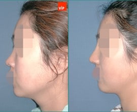 Septal cartilage rhinoplasty