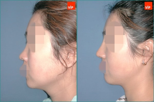 Nose Surgery - Septal cartilage rhinoplasty