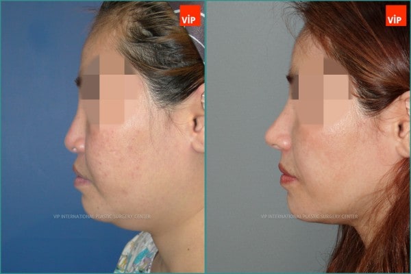 Nose Surgery - Rib cartilage rhinoplasty