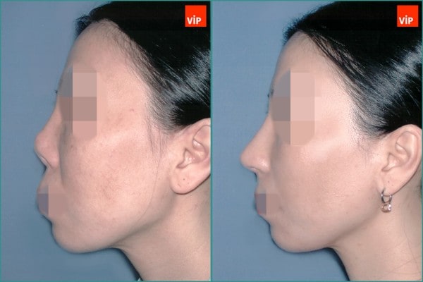 Nose Surgery - Contracted nose / Rib cartilage rhinoplasty