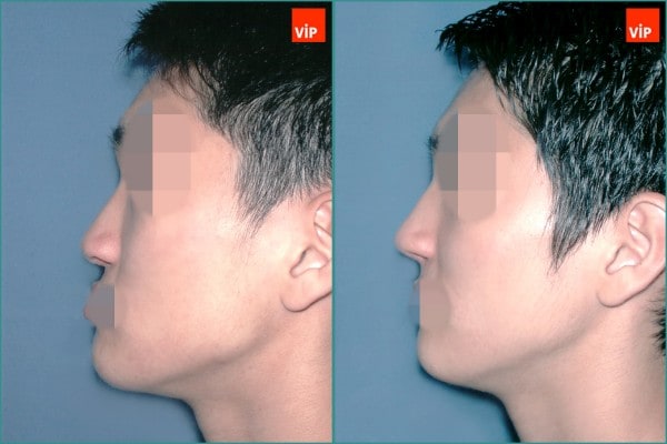 Nose Surgery - Rib cartilage rhinoplasty