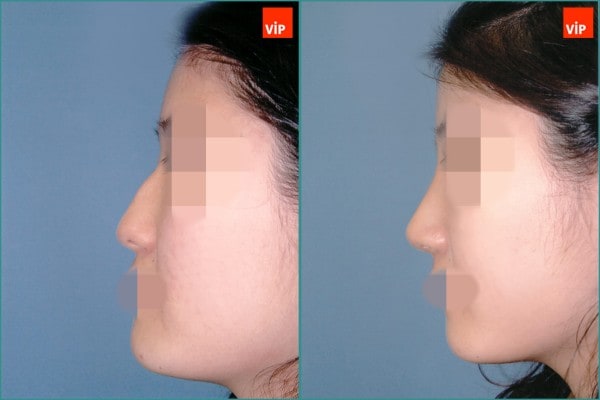 Nose Surgery - Hump nose