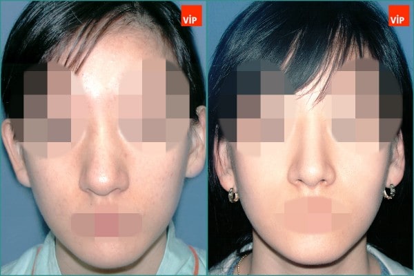 Nose Surgery - Septal cartilage rhinoplasty