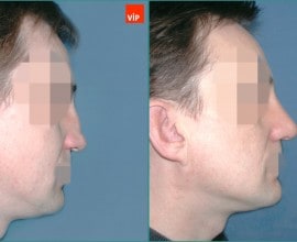 Septal cartilage rhinoplasty