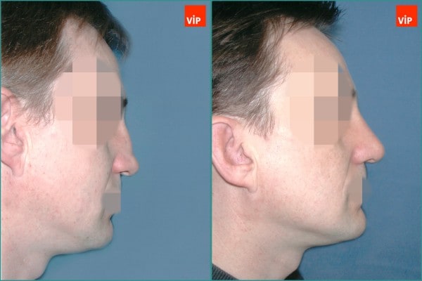 Nose Surgery - Septal cartilage rhinoplasty