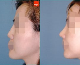 Septal cartilage rhinoplasty