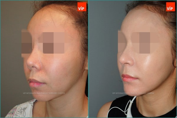 Nose Surgery - Rib cartilage rhinoplasty