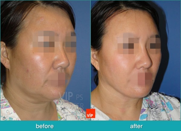 Face Lift - High SMAS Face / Necklift