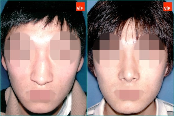 Nose Surgery - Droopy nose