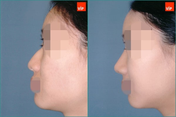 Nose Surgery - Hump nose