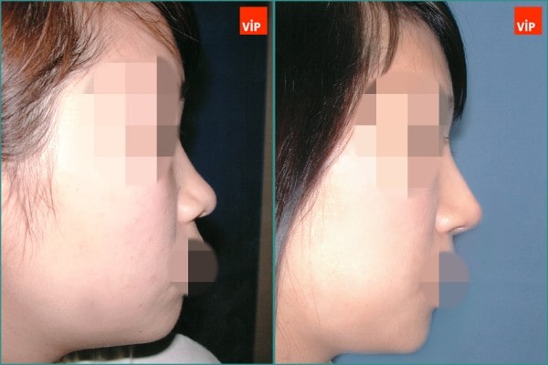 Nose Surgery - Septal cartilage rhinoplasty