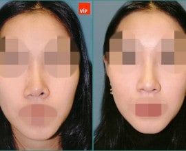 Septal cartilage rhinoplasty