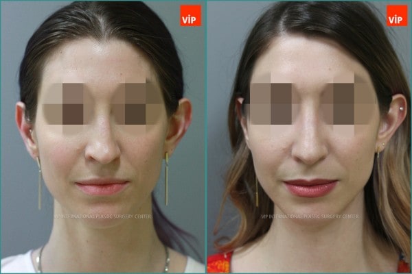 Nose Surgery - Septal cartilage rhinoplasty, Septal Deviation