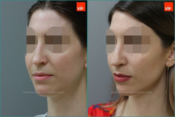 Nose Surgery - Septal cartilage rhinoplasty, Septal Deviation