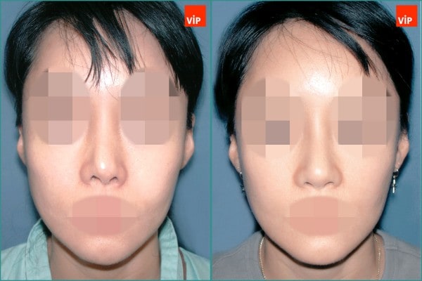 Nose Surgery - Rib cartilage rhinoplasty