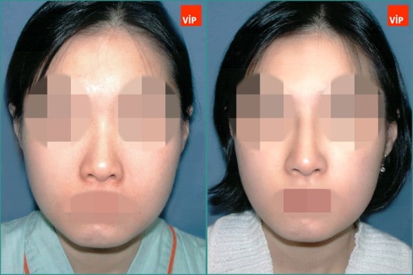 Nose Surgery - Rib cartilage rhinoplasty