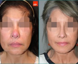 Face lift / Revision rhinoplasty / Rib cartilage rhinoplasty