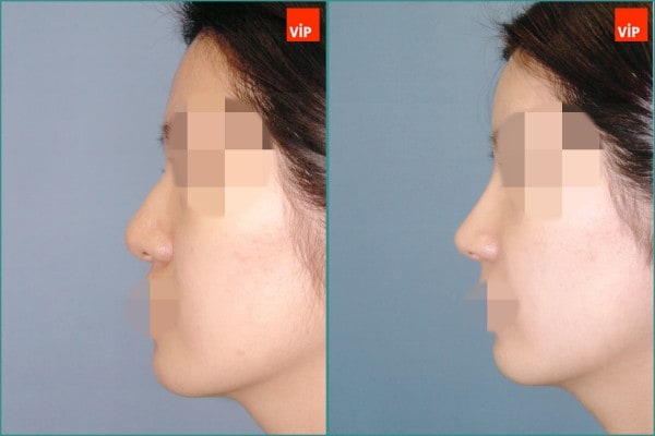 Nose Surgery - Hump nose