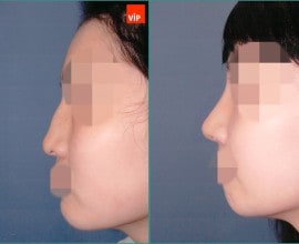 Septal cartilage rhinoplasty