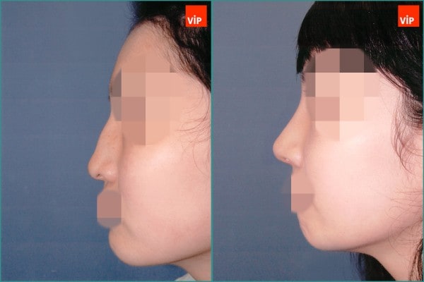 Nose Surgery - Septal cartilage rhinoplasty