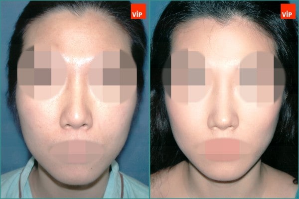 Nose Surgery - Septal cartilage rhinoplasty