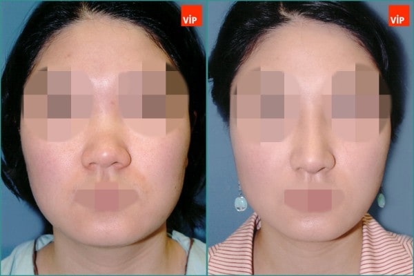 Nose Surgery - Septal cartilage rhinoplasty