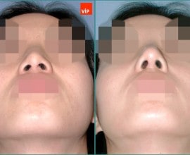 Septal cartilage rhinoplasty