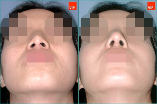 Nose Surgery - Septal cartilage rhinoplasty