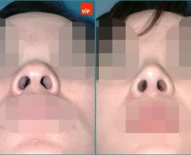 Septal cartilage rhinoplasty