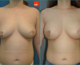 Breast Surgery