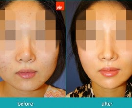 Face Contouring Surgery, V-line Jaw Reduction, Harmony Rhino…