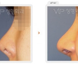 Rib cartilage rhinoplasty