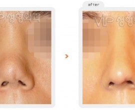 Revision rhinoplasty