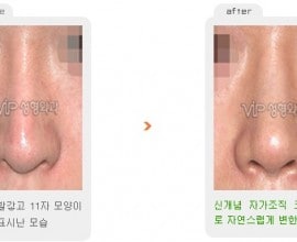 Revision rhinoplasty - Silicone showing nose