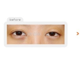 Incision double eyelid surgery