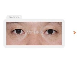 Upper & Lower blepharoplasty