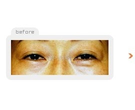 Upper & Lower blepharoplasty