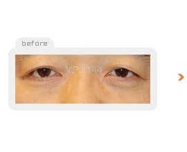 Upper & Lower blepharoplasty