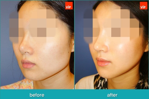 	Nose Surgery, Rib cartilage Rhinoplasty, Facial Bone Surgery	 - Face Contouring Surgery, V-line Jaw Reduction, Harmony Rhinoplasty using Rib Cartilage