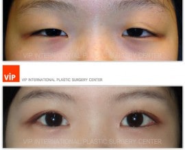 Ptosis correction