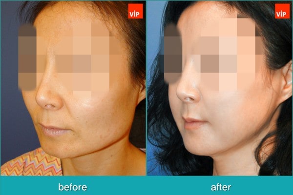 	Facial Bone Surgery, Stem Cell Fat Graft	 - Face Contouring Surgery, V-line Jaw Reduction, Fat Graft, Cheekbone Reduction