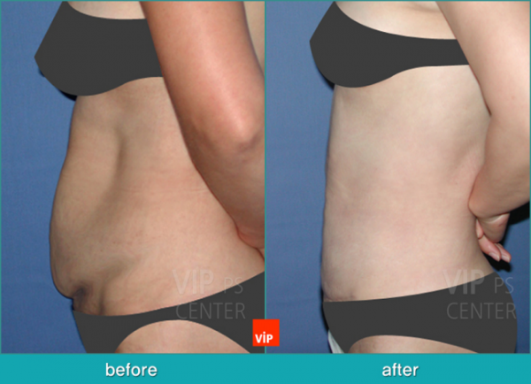 	Body Contouring	 - Liposuction