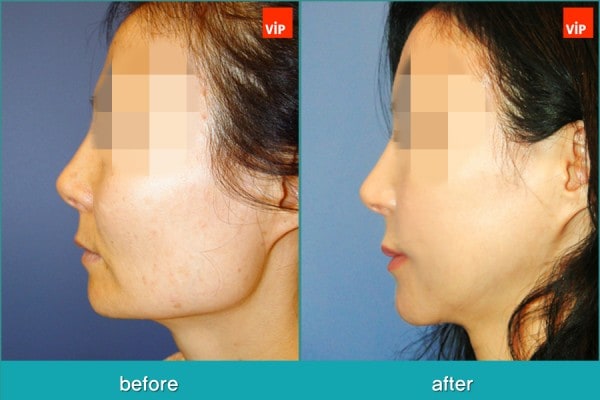 	Facial Bone Surgery, Stem Cell Fat Graft	 - Face Contouring Surgery, V-line Jaw Reduction, Fat Graft, Cheekbone Reduction