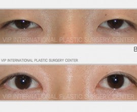 eyelid surgery