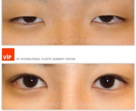 Ptosis Correction