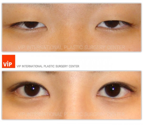 	Eye Surgery, Double Fold, Ptosis Correction	 - Ptosis Correction