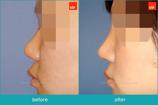 	Nose Surgery, Each Cases Nose	 - Nose Surgery